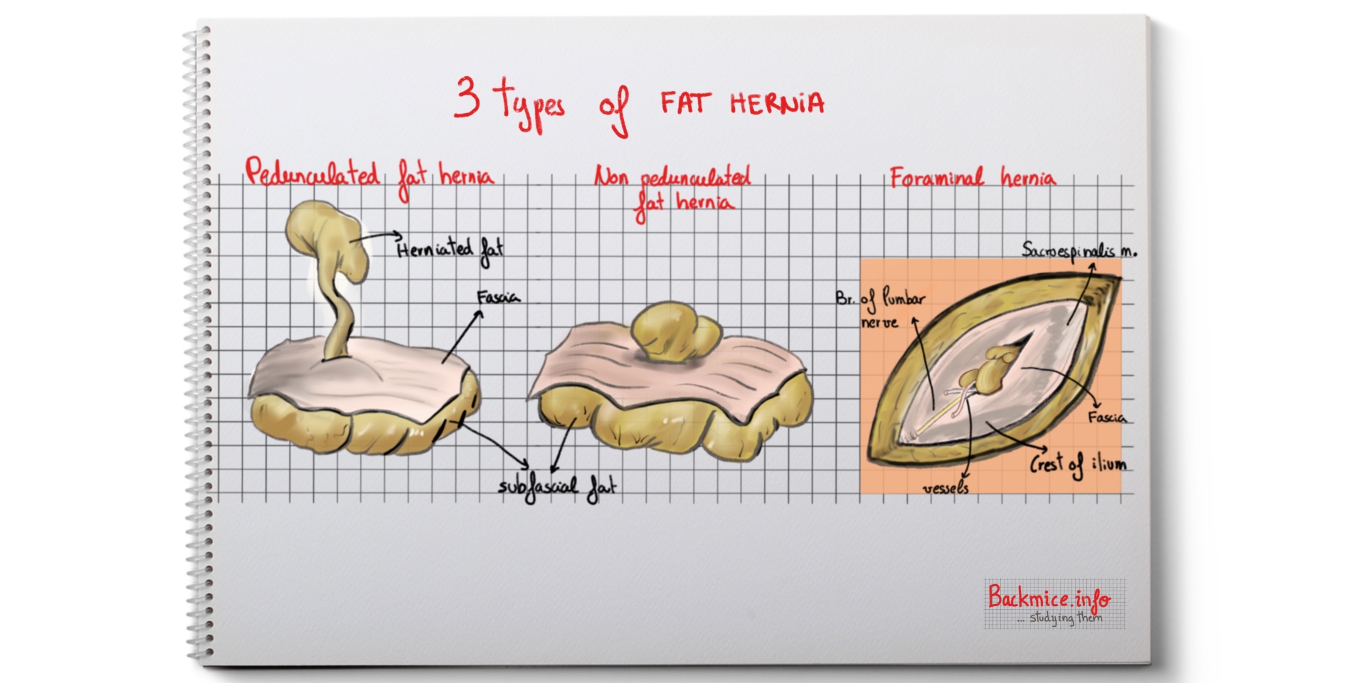 herniation of fat lobules