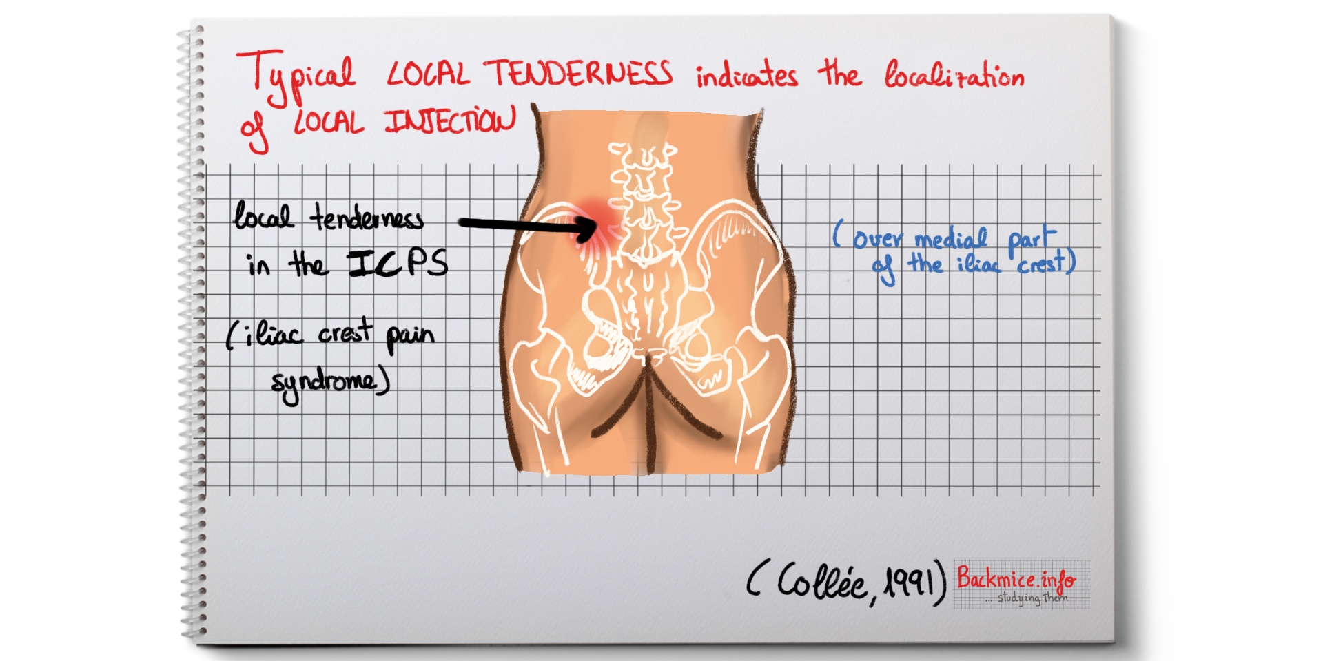 pain along iliac crest