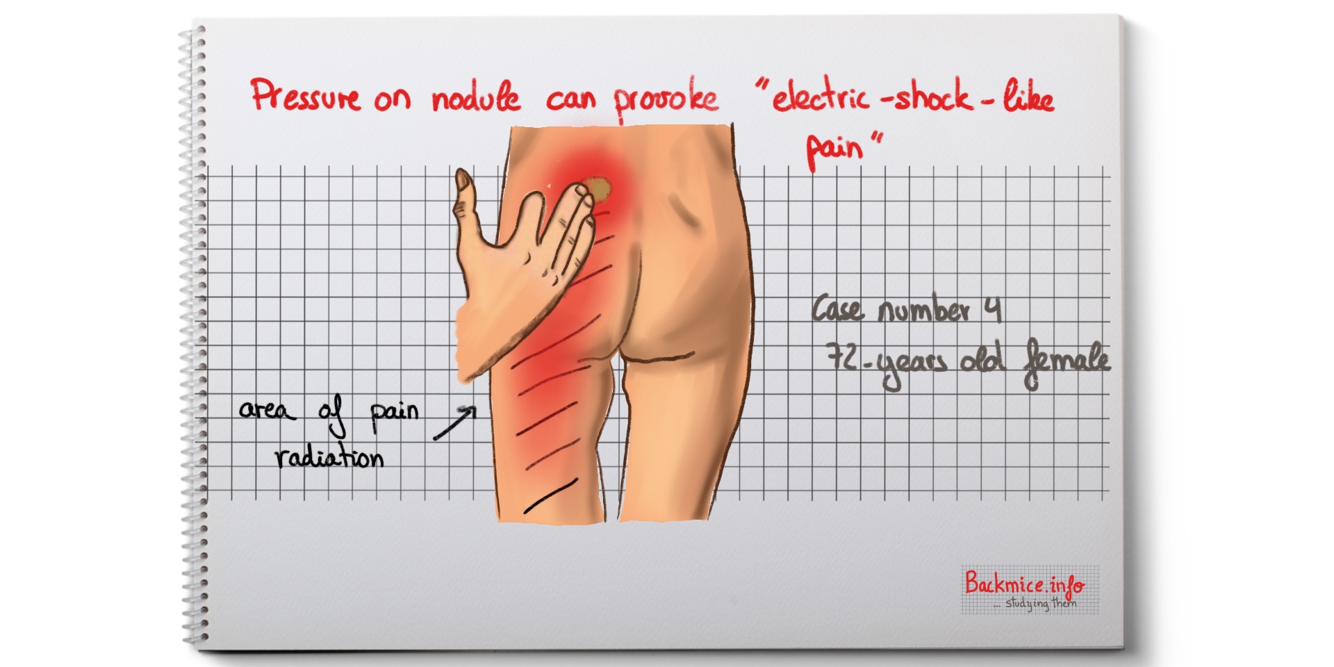 sacroiliac lipoma and low back pain (paplpation on the nodule)