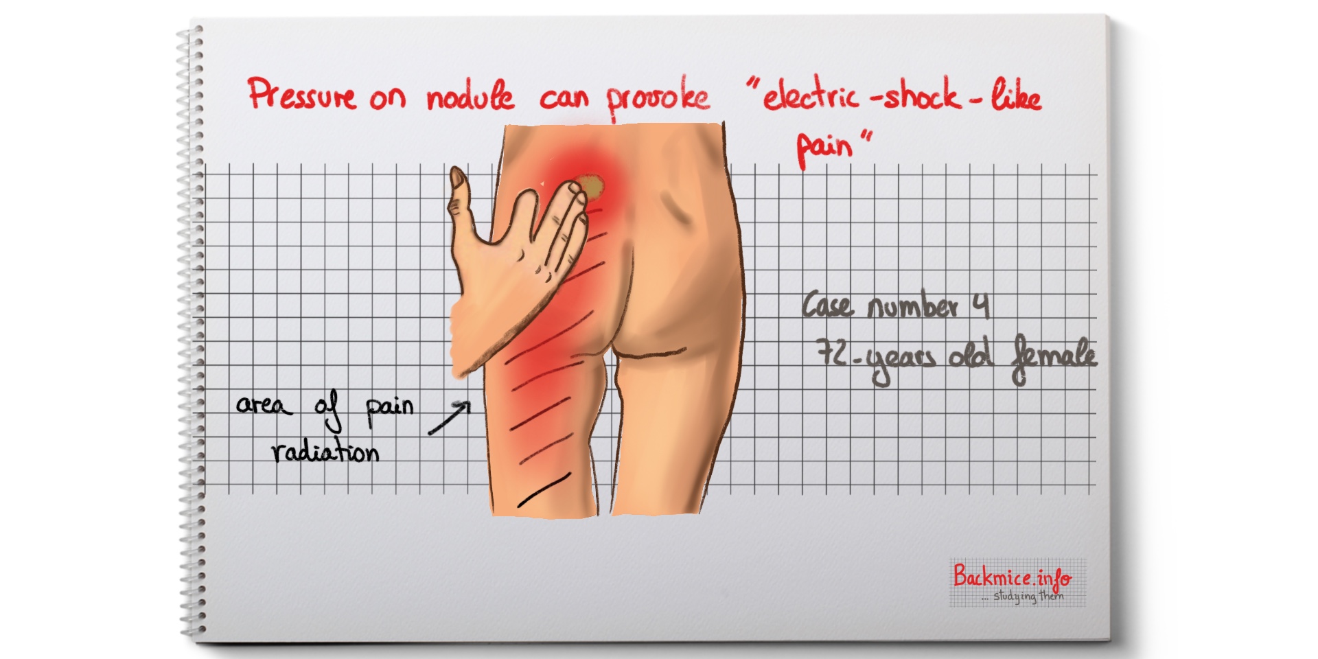 Sacroiliac Lipoma and Low Back Pain. (back mice).