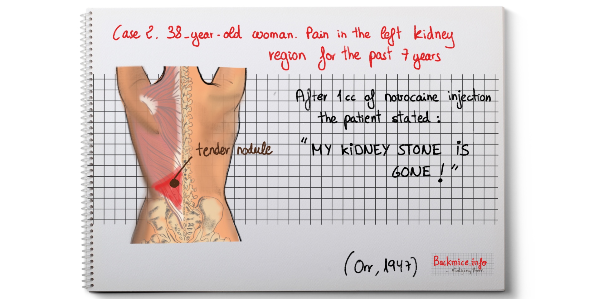 After 1cc of novocaine injection the patient stated: "my kidney stone is gone"
