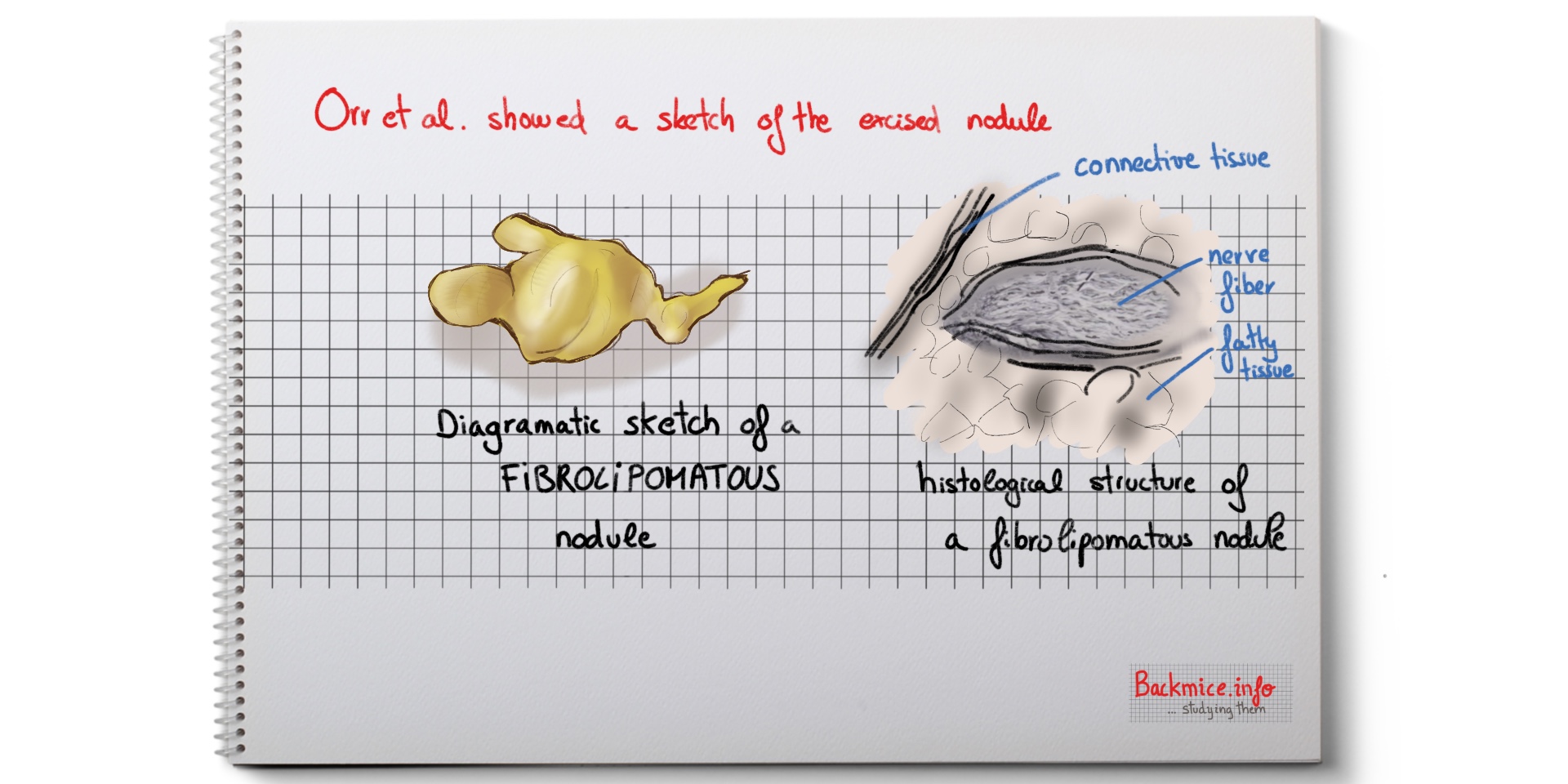 Diagramatic sketch of a fibrolipomatous nodule ("back mice")