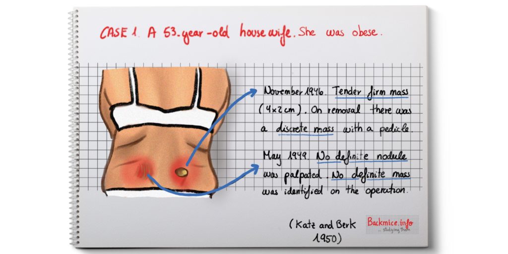 episacroiliac lipomas