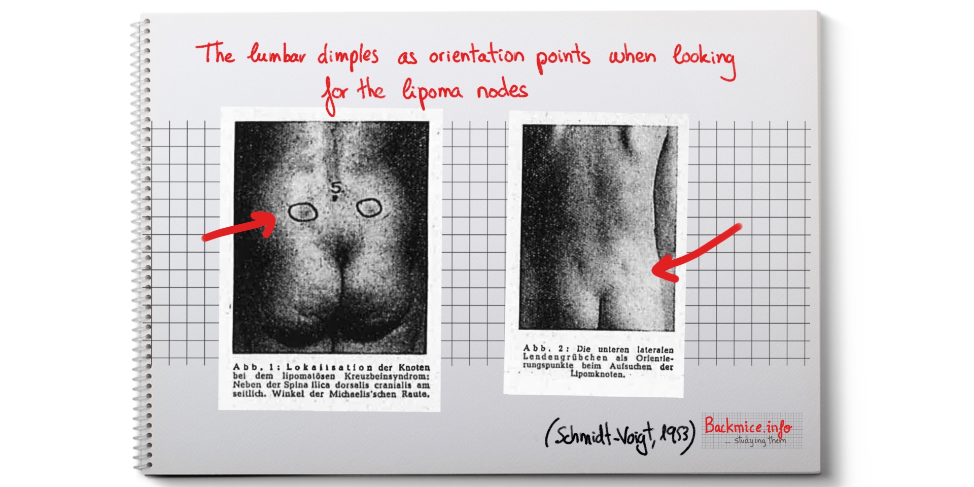 The lumbar dimples as orientation points when looking for the lipoma nodes