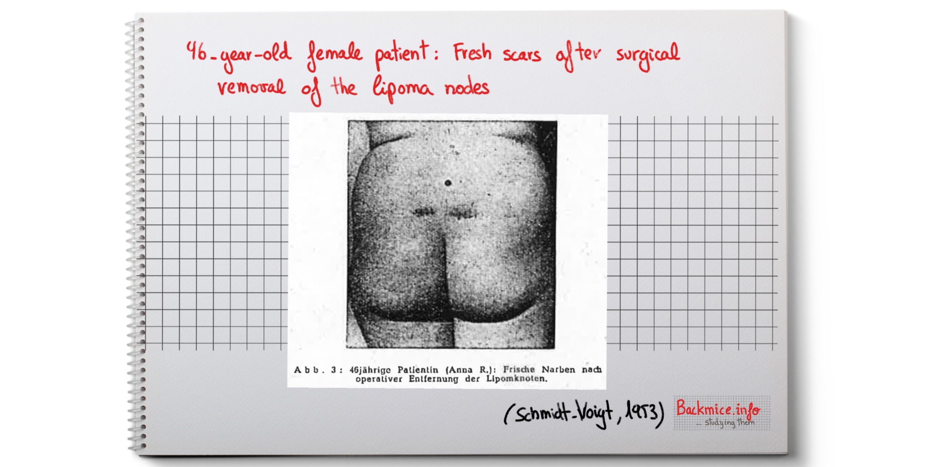 Fresh scars after surgical removal of the lipoma nodes (lipomatose kreuzbeinsyndrom)