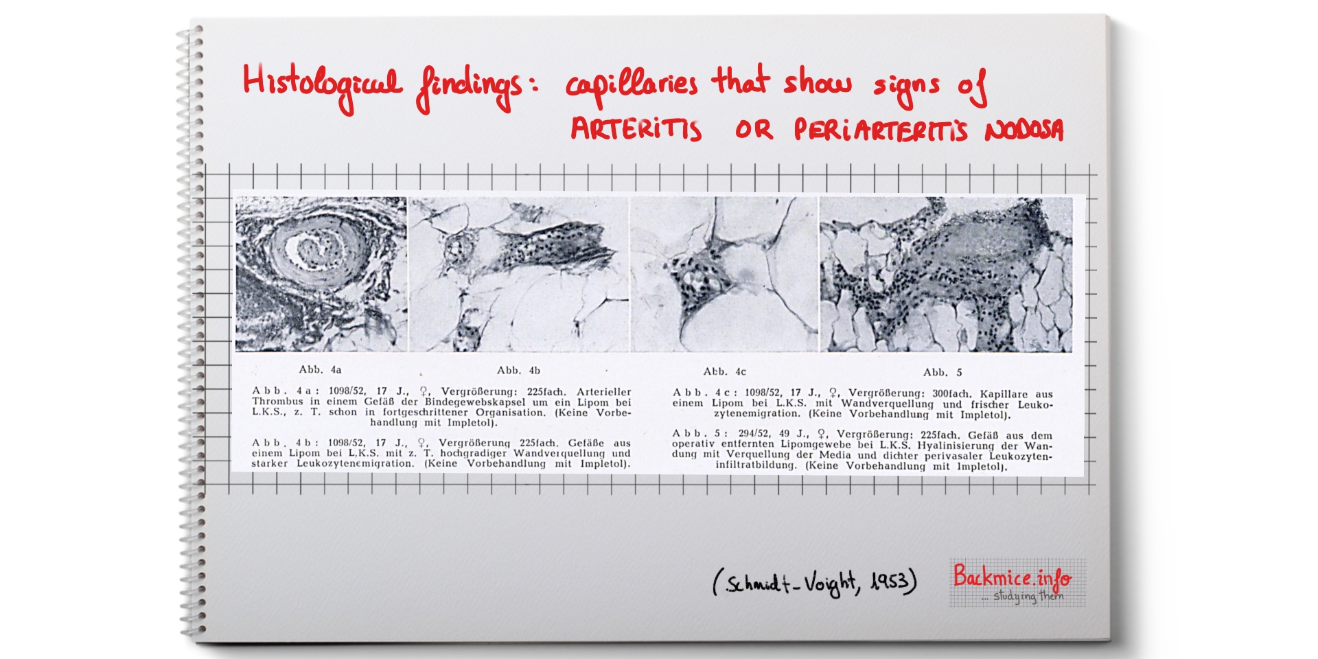 Histological findings (capillaries that show signs of arteritis or periarteritis