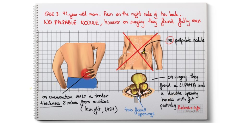 sacro-iliac lipoma