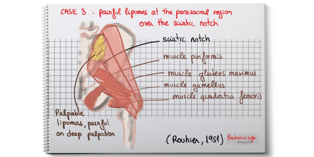 painful lipomas