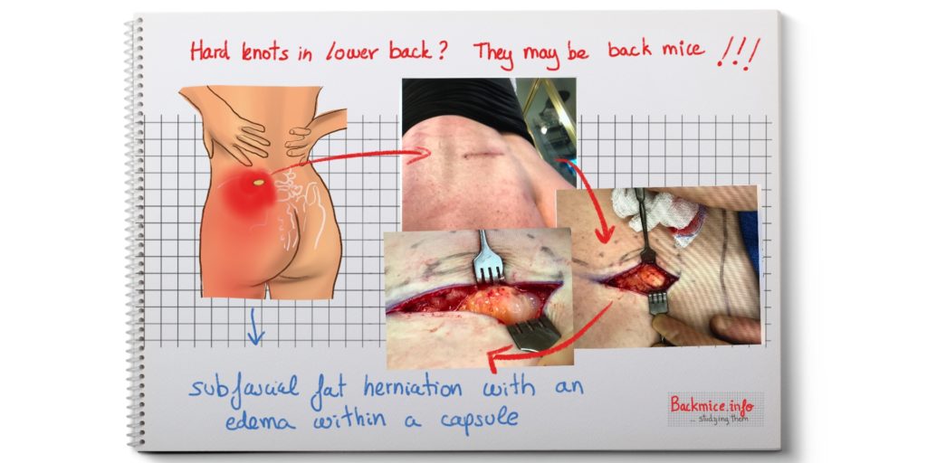 Back Mice Symptoms, Diagnosis, and Treatments